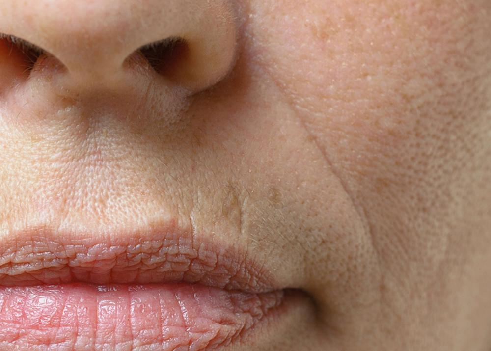 Piel con líneas de expresión