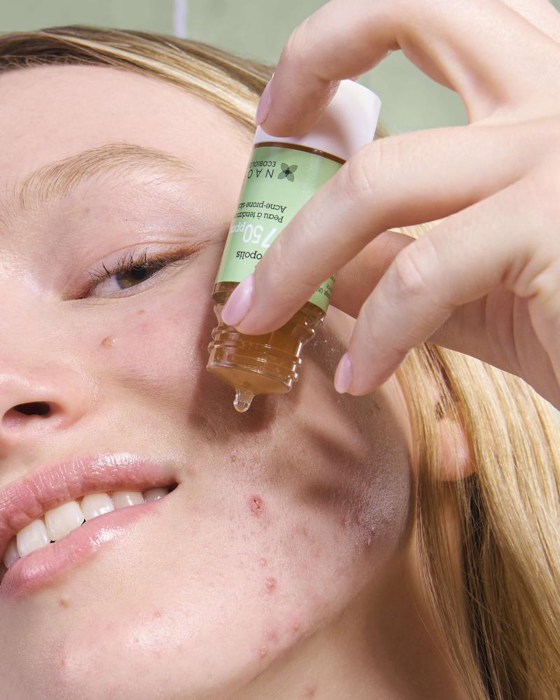 Joven con Acné retencional (comedogénico) aplicanco en su rostro Ácido Salicílico 2% de Etat Pur